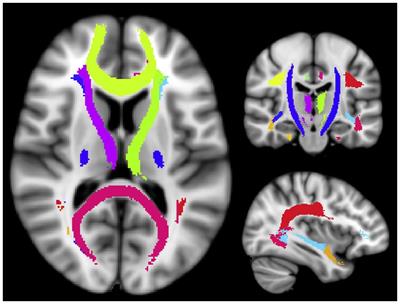 Sex, myelin, and clinical characteristics of Parkinson’s disease